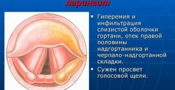 Синдром надгортанника лечение