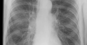 Можно ли курить перед флюорографией