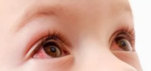 У ребенка красные глаза и температура