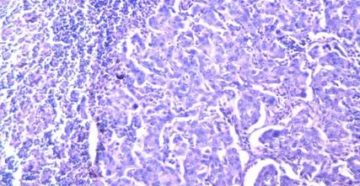 Низкодифференцированная аденокарцинома легкого