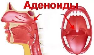 Где находятся аденоиды у человека