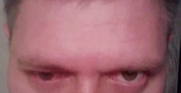 Опух лоб над бровями