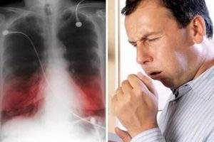 Аллергическая пневмония симптомы