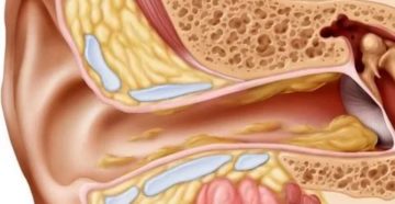 Почему в ушах образуется много серы