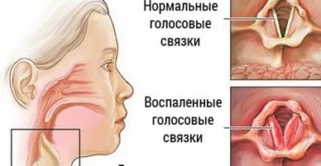 Перенапряжение голосовых связок лечение