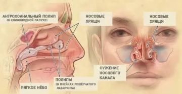 Постоянно закладывает одну ноздрю