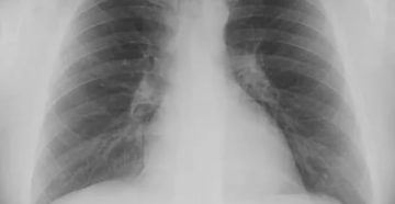 Рентгенограмма легких в норме