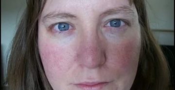 Почему щеки красные постоянно