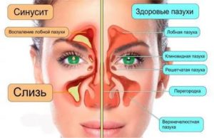 Ринит и гайморит разница