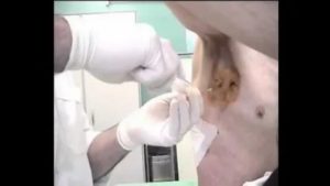 Пункция легких как делают