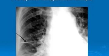 Уплотнение междолевой плевры справа что это