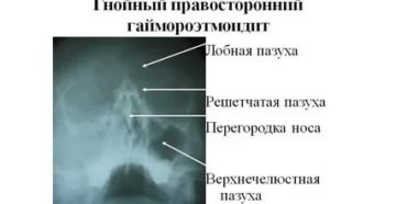 Рентген онп что это