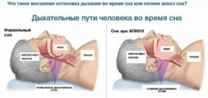 Задержка дыхания во сне у взрослых причины