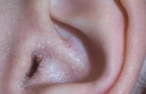 Корочки в ушах у человека лечение