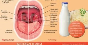 Долго не проходит горло температуры нет