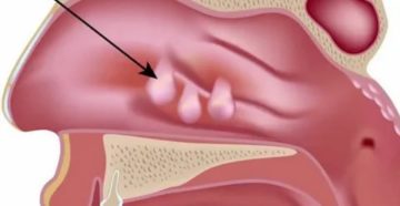 Гиперплазия слизистой носовых ходов