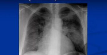 Пульмонит что это такое