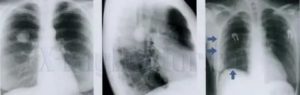 Как выглядит рак легких на рентгене фото