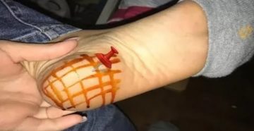 Можно ли мазать пятки йодом