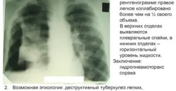Плевральные спайки в легких что это