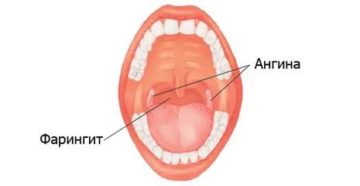 Как отличить тонзиллит от ангины