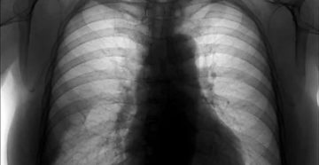 Посттуберкулезный пневмофиброз