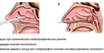 Двухсторонняя нижняя щадящая конхотомия
