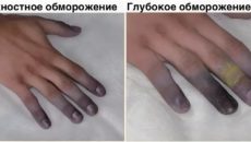 Нетипичные последствия переохлаждения 2 рассказ