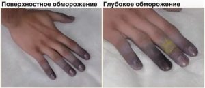 Нетипичные последствия переохлаждения 2 рассказ