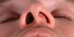 Рак слизистой носа симптомы фото
