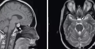 Синусопатия головного мозга что это такое