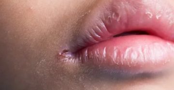 Заеды у детей комаровский Заеды у детей комаровский