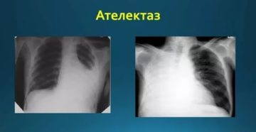 Ателектаз легкого рентгенограмма
