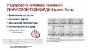 Тахикардия при температуре