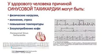 Тахикардия при температуре