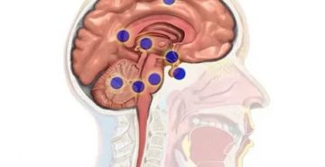 Полипы в головном мозге