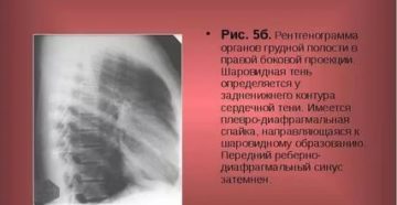 Плевро диафрагмальная спайка справа