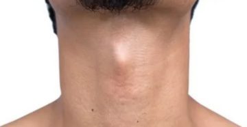 Большой кадык признак чего