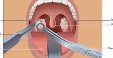 Нужно ли удалять миндалины ребенку