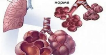 Буллы в легких как лечить