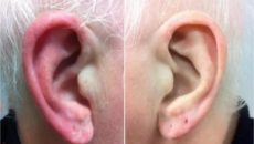 Симптомы сломанного уха