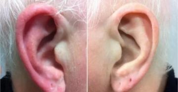 Симптомы сломанного уха