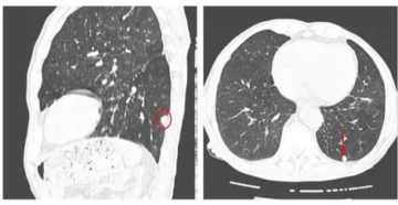 Субплевральные очаги в легких что это