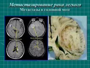 Рак легких с метастазами в головной мозг