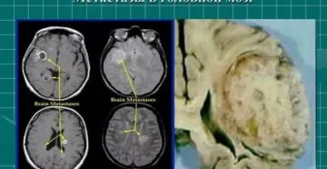 Рак легких с метастазами в головной мозг