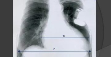 Диафрагмальные спайки в легких