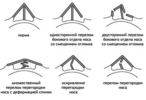 Сломанный нос какая степень тяжести