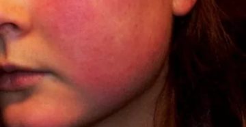 Почему красные щеки у подростка