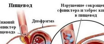 Выброс кислоты из желудка в горло ночью