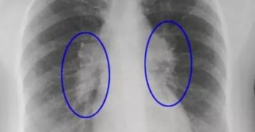 Фиброзные тяжи в легких что это такое